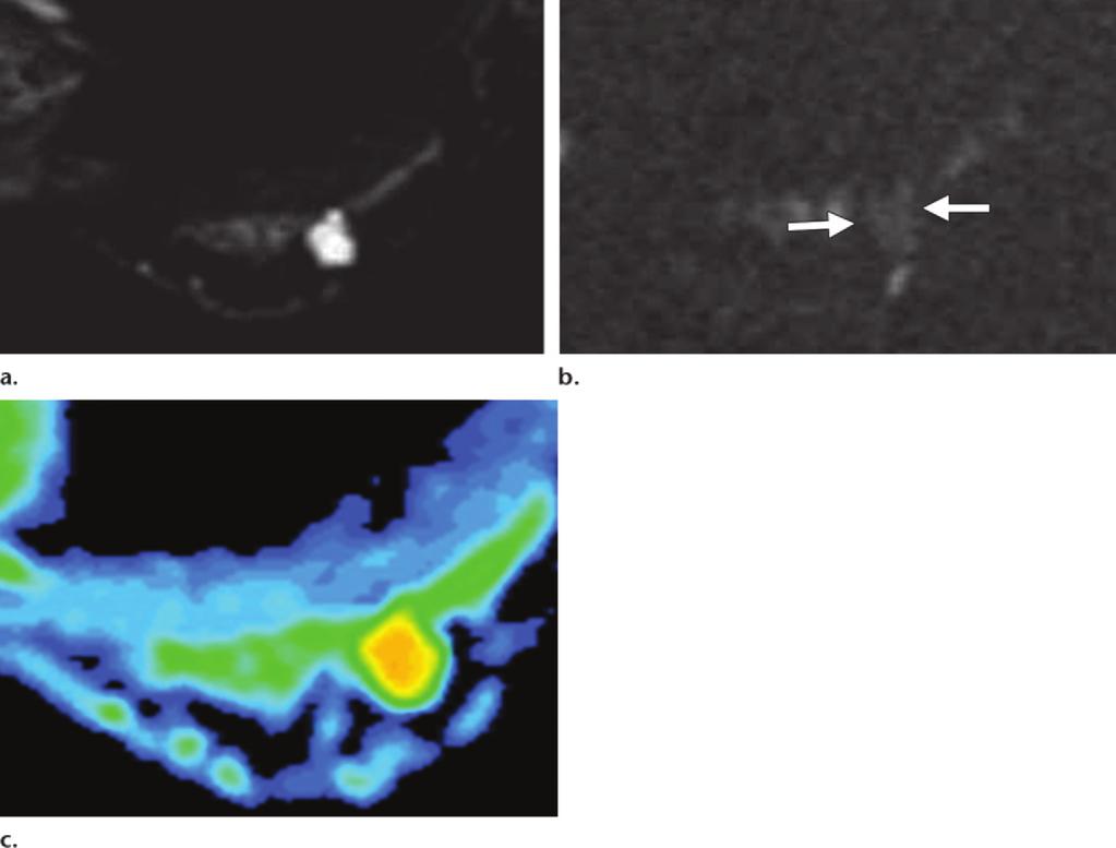 Bilateral areas of diffuse nodular enhancement are observed in the breasts. (b) Diffusion-weighted image obtained at b = 1500 sec/mm 2 (spin-echo echoplanar imaging, TR/TE = 7800/88.