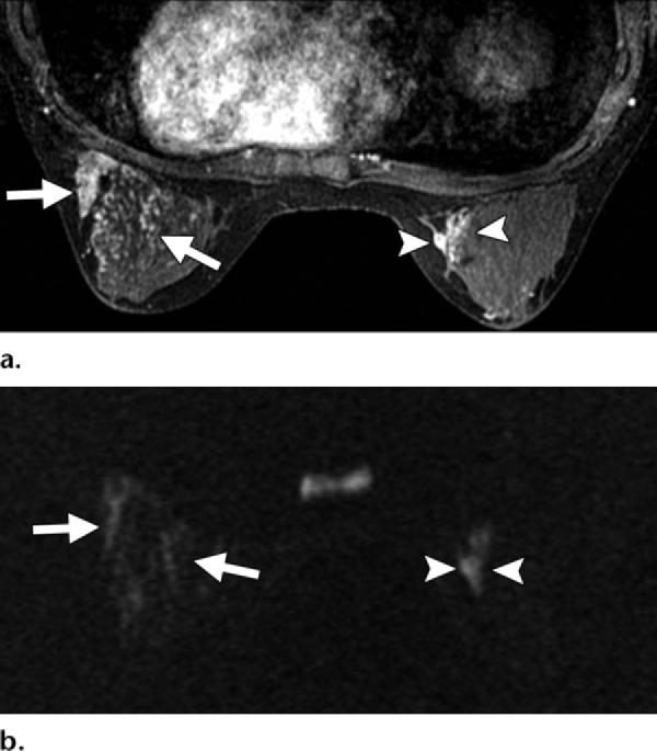 RG Volume 31 Number 4 Woodhams et al 1077 Figure 19. Bilateral fibrocystic disease in the breasts. (a) Contrast-enhanced T1-weighted MR image (VIBRANT, TR/TE = 6.5/3.