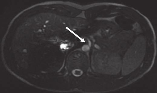 irkemeier et al. Fig. 5 18-year-old man with pectus excavatum., Image was obtained at full expiration. Origin of celiac artery (arrow) is displaced and acutely angulated.