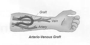compressed, so flow will only be on one side Listen for side with the bruit that s the arterial side Photo courtesy of Dr.