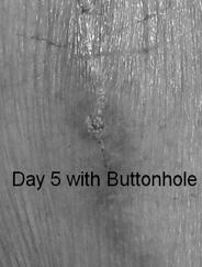 Buttonhole Technique Reuse same sites each treatment Uses blunt needles Scab removal required Must follow the track of the original cannulator Side-to-side technique For AV fistulae only 18