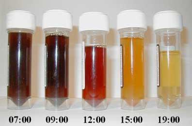 Nocturnal hemoglobinuria, not clear why morning urine is enriched in hemoglobin