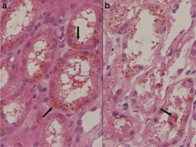 Accumulation of hemoglobin breakdown products in kidney tubule eventually leads to tubule