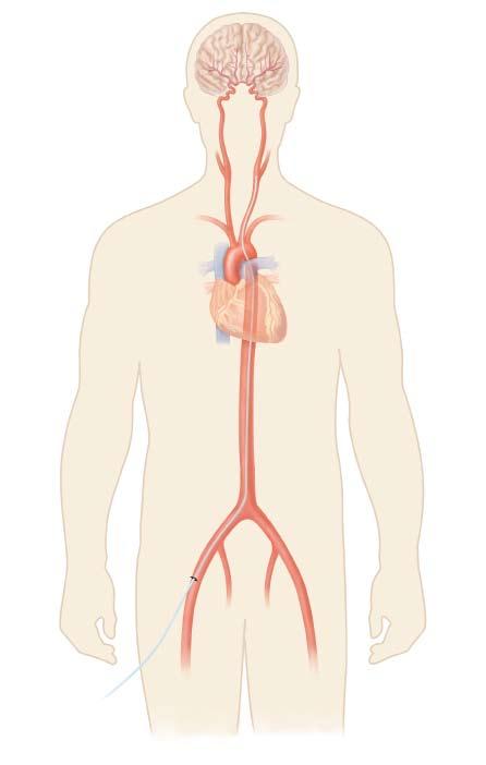 The Procedure During the procedure, a long thin tube called a catheter is inserted into the. This is used to move instruments through the to put the stent in place.