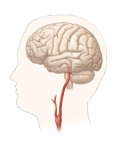 How a Stroke Can Occur Blood carries oxygen and nutrients to wherever they re needed in the body. The brain needs a steady supply of blood to work.