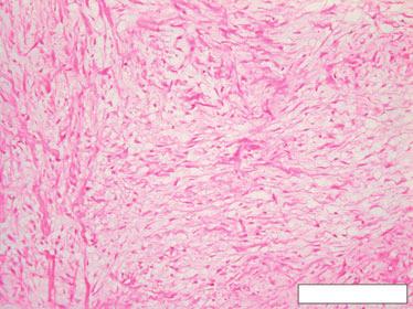 Odontogenic tumors Fig. 17. The odontogenic myxoma contains more delicate, dispersed collagen fibers, between which is glycosaminoglycan, which gives the tumor its mucinous consistency.