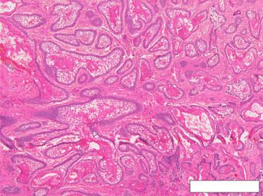 Morgan Fig. 2. Follicular variant of the conventional solid multi cystic ameloblastoma.
