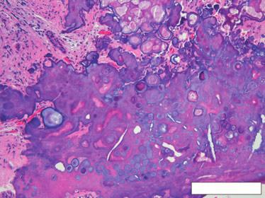 Odontogenic tumors Fig. 8. Calcifying epithelial odontogenic tumor (Pindborg tumor).