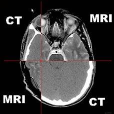 IMAGING CT scans (Treatment planning) Small slice thickness(1mm slice) Contrast agent Low localization
