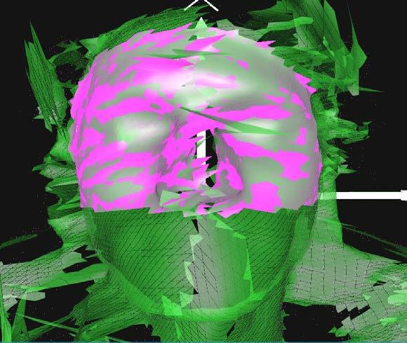 Intrafraction motion management Orthogonal kv imaging (2D-3D imaging) ExacTrac (BrainLAb) Cyberknife Proton treatment Optical 3D surface imaging (AlignRT/OSMS)-LUMC Dual camera system in each pod