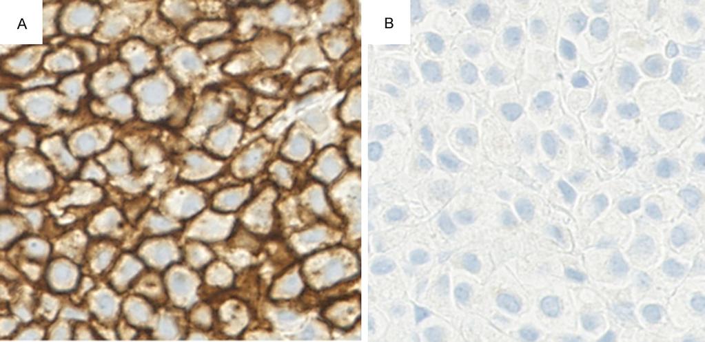 Figure 2. Immunohistochemical findings of the plasmacytoid variant. A. Positive for CD138 ( 400). B. Negative for E-cadherin ( 400). Figure 3. Schema of the bladder carcinoma in the present case.