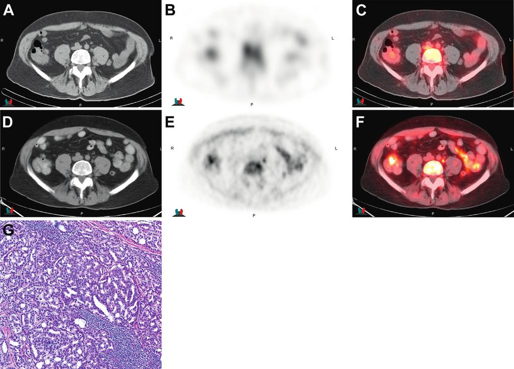 TOMOGRAPHY FOR RECURRENT PROSTATE CANCER 1451 Figure 2. Imaging in 65-year-old patient after external beam radiation therapy and cryotherapy with increasing PSA to 13.