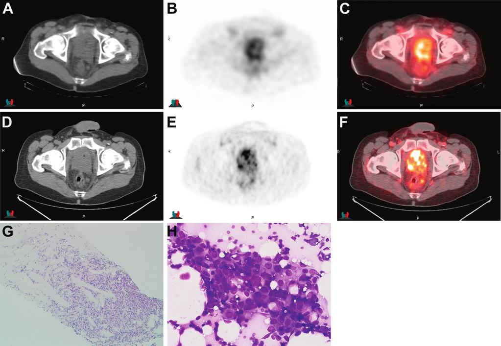 1452 TOMOGRAPHY FOR RECURRENT PROSTATE CANCER Figure 3. Imaging in 61-year-old patient after external beam radiation therapy and hormonal therapy with increasing PSA to 1.