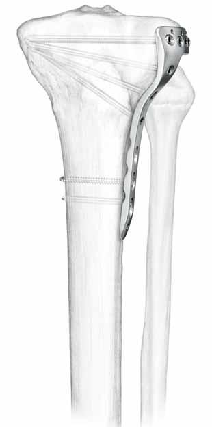 3.5 mm LCP Proximal Tibia Plate. Part of the Synthes Small Fragment LCP System. The 3.