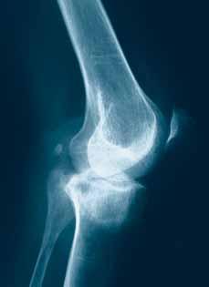 Contraindications Isolated shaft fractures Children in period of growth Osteotomies Sepsis Compromised vascularity Malignant primary or metastic tumours Heavy/obese patients Non-compliant patients
