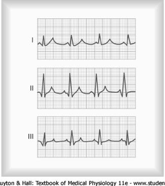The Normal Electrocardiogram ECG from Standard Bipolar Limb Leads All leads depict the P wave, QRS complex, and T wave Further, the sum of potentials in leads I and III equals the potential observed