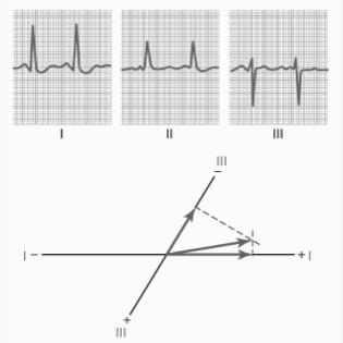 Causes of Axis Deviation Electrocardiographic Interpretation Left ventricular hypertrophy Enlarged left ventricle causes axis to shift towards the left ventricle Increased