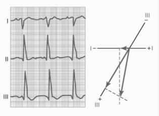 Causes of Axis Deviation Electrocardiographic Interpretation Bundle branch block Ventricles normally depolarize at the same time due to the quick conduction within the Purkinje system If one side of