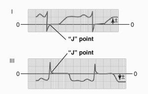 Current of Injury Electrocardiographic Interpretation A vector analysis can be utilized to identify the location of the current of injury Injured area is in the lateral wall of the right ventricle
