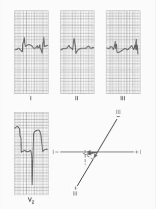 Interpretation Acute Anterior Wall Infarction V2: J point and zero line define a large negative potential during the T-P segment Chest electrode over the front of the heart is highly negative