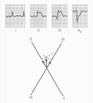 Posterior Wall Infarction Electrocardiographic Interpretation V2: J point and zero line define a large positive potential during the T-P segment Posterior wall infarction II and III:
