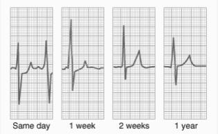 up Infarction of the heart apex on the posterior wall of the left ventricle Recovery From Infarction Electrocardiographic Interpretation After an infarction, a V3 chest lead can depict