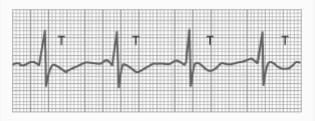 T Wave Abnormalities Electrocardiographic Interpretation Slow conduction of depolarization Prolonged depolarization