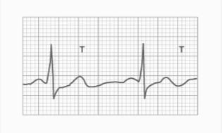 abnormal rhythm of the heart Asynchronous arterial - ventricular contraction Typical cardiac arrhythmias include Abnormal