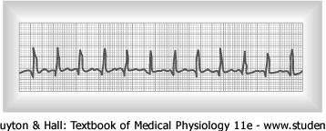 Cardiac Arrhythmias & Electrocardiograms Abnormal Sinus Rhythms Tachycardia refers to a fast heart rate, greater than 100 beats per minute, and can occur for a variety of reasons Increased body