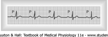 Cardiac Arrhythmias & Electrocardiograms Abnormal Impulse Conduction Sinoatrial block occurs when the impulse from the sinus node is blocked before it enters the atrial muscle In ECGs, S-A block is