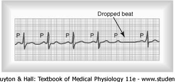 Cardiac Arrhythmias & Electrocardiograms Abnormal Impulse Conduction Second Degree Block When the P-R interval is 0.25 to 0.