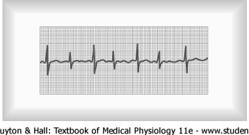 Arrhythmias & Electrocardiograms Abnormal Impulse Conduction Incomplete Intraventricular Block Blockage in the peripheral portions of the