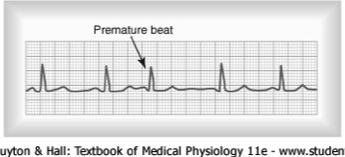 Cardiac Arrhythmias & Electrocardiograms Premature Contraction Typically premature contraction, or the contraction of the heart before it would normally be expected, results from an ectopic foci
