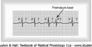conductory system due to drugs, nicotine, or caffeine Premature Atrial Contraction: Ectopic origin near the AV node causes a premature P wave, along with a shortened P-R interval and a succeeding