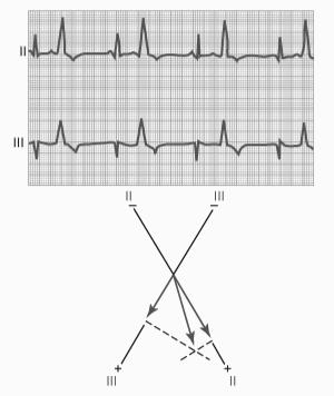 Ventricular Contraction QRS complex is usually prolonged as the conducting material is mainly muscle rather than the Purkinje fibers QRS voltage is high since ventricular depolarization is serial