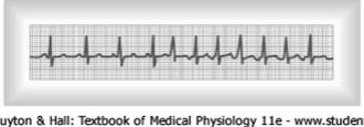 Cardiac Arrhythmias & Electrocardiograms Paroxysmal Tachycardia Abnormalities in any portion of the heart can cause the rapid rhythmical discharge of impulses that spread throughout the heart Because