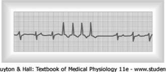 seconds, minutes, or hours, and then quickly disappears - allowing the sinus node to take over as pacemaker Atrial paroxysmal tachycardia can occur Note inverted P wave Ventricular paroxysmal