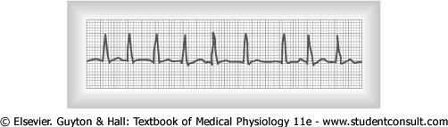 Cardiac Arrhythmias & Electrocardiograms Atrial Fibrillation In atrial fibrillation, the resulting ECG is very irregular No or little P waves are present QRS-T wave complex is unaffected Ventricular