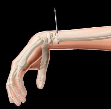 The pins should be parallel to the radiocarpal  If full independent pin placement is
