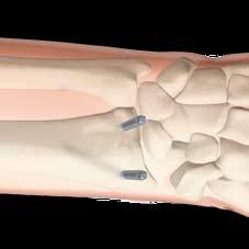 radial carpal joint in the AP view.