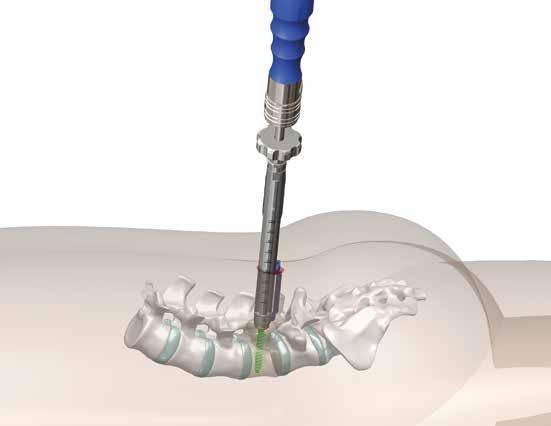 percutaneous approach, having the screw already coupled with a dedicated connector for subsequent blade and frame coupling. For this technique, cannulated screws and percutaneous tubes are used.