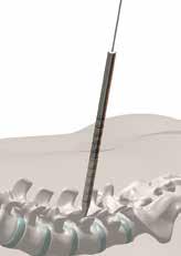 1 Pedicle Preparation Target the pedicle and perforate the outer cortex with the Cannulated Awl. 3.2 Dilator Insertion Multi-Step Dilation Insert the Dilator size 1 8mm over the k-wire.