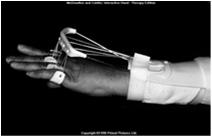 Anti-claw orthosis Preoperative Orthoses MEDIAN NERVE Web spacer Short opponens (ASHT test prep book, p.