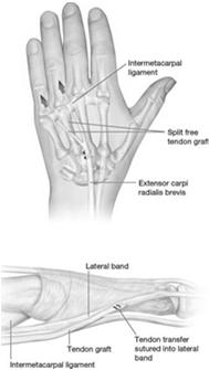Ulnar Nerve HIGH LOW Muscle loss FCU FDP RF/SF AP and 1st DI FPB deep head Lumbricals RF/SF Interossei Functional deficit Weak wrist flexion / UD Loss of power grip Loss of key pinch (Froment