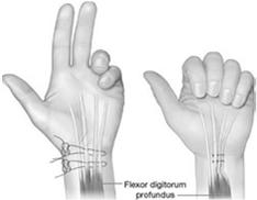 function via MCP joint flexion (and IP joint extension if negative Bouvier test) * Restore pinch: Restore thumb adduction (and IF abduction prn) * Restore RF/SF DIP flexion Ulnar Nerve Intrinsic Plus
