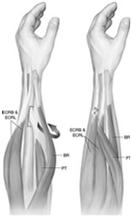 Radial Nerve PT ECRB/L to restore wrist extension FCU, FCR, or FDS EDC to restore finger extension PL or FDS EPL to