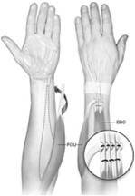 html) Radial Nerve Postoperative Post-op immobilization Long-arm orthosis 90 elbow flexion, forearm pronation, 30-45