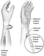 weeks May be able to switch to wrist cock-up at 6 weeks Mobilization starts at 3-4 weeks Gentle isolated AROM of each