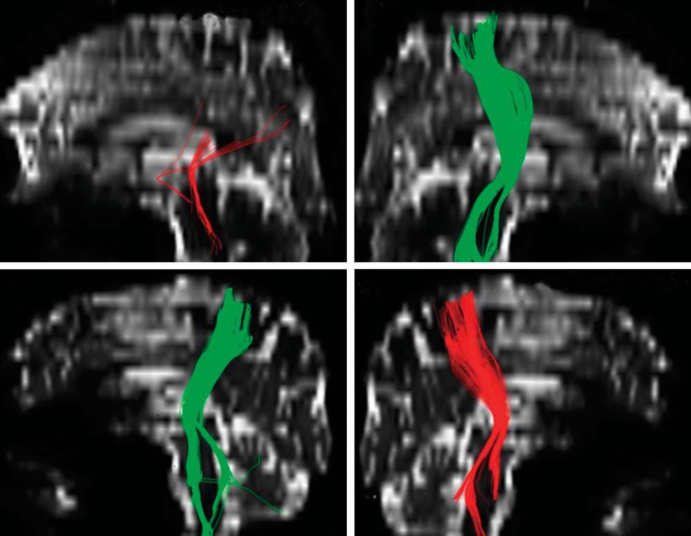 L Lesional hem R L R Lesional hem Figure 3. Diffusion tensor imaging and stroke recovery potential.