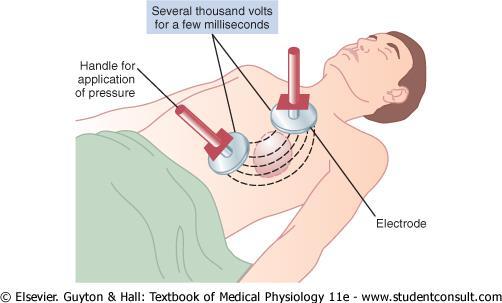 Defibrillation A strong high-voltage alternating electrical current passed through the ventricles Stops fibrillation by throwing all
